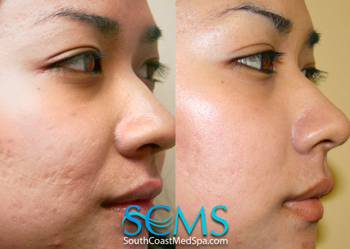 Before and after results from acne scar treatment atSouth Coast Med Spa in Brea