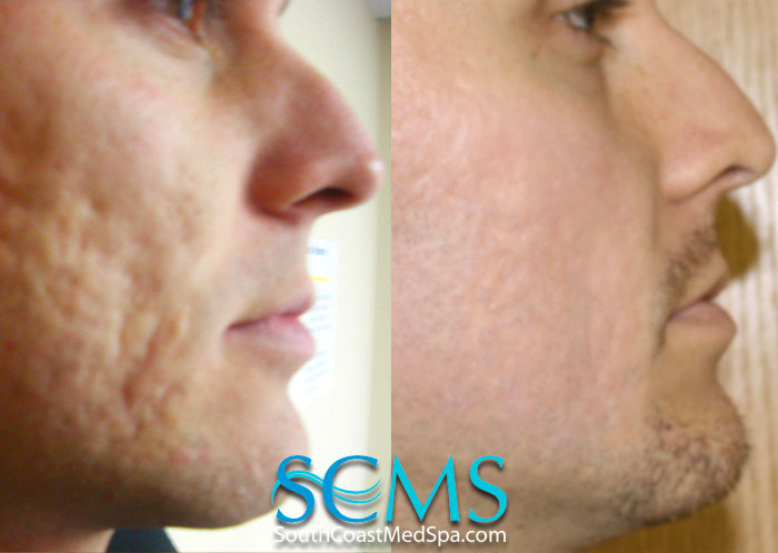 Acne scar treatment results from South Coast Med Spa in Brea
