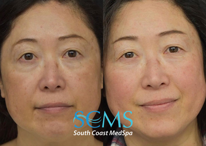 Skin treatment results from South Coast Med Spa in Brea