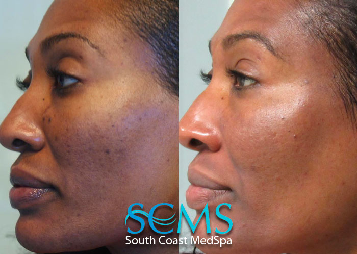 Acne treatment results from South Coast Med Spa in Brea