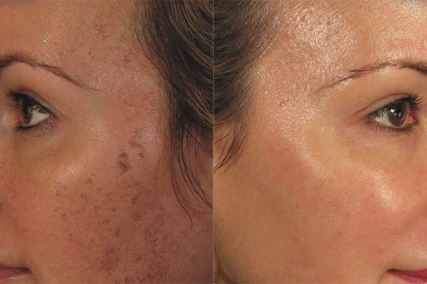 Before and after photos of skin rejuvenation in San Diego South Coast MedSpa.