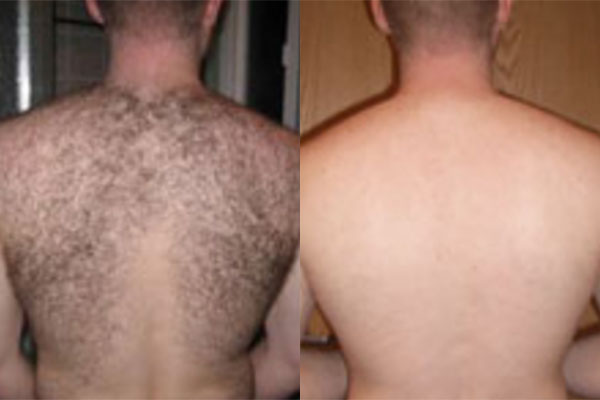 before and after photos of a man first with a hairy back, then no more back hair after laser hair removal in Newport Beach.