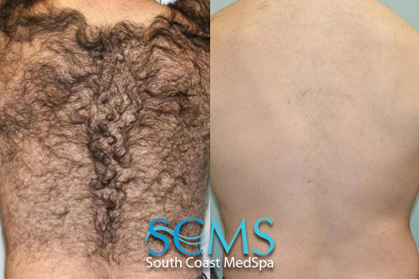 Laser Hair Removal South Coast MedSpa