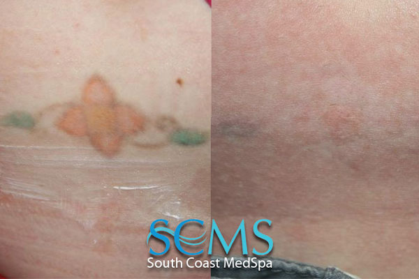 patient before and after laser tattoo removal in Brea