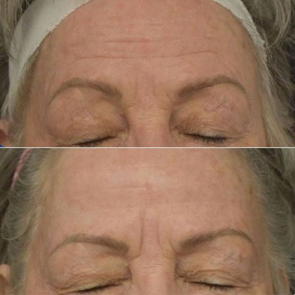 woman before and after Morpheus8 in Brea