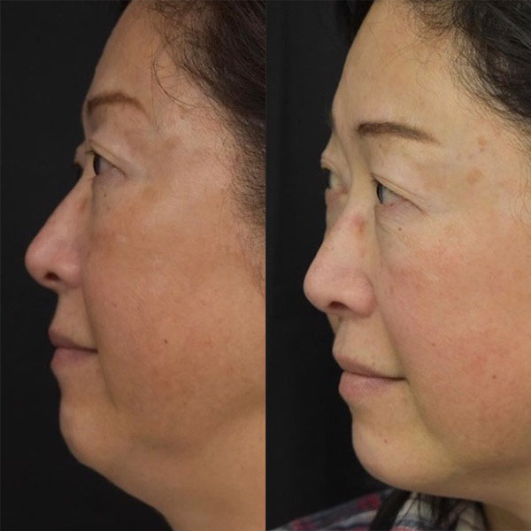 woman before and after Morpheus8 in Brea