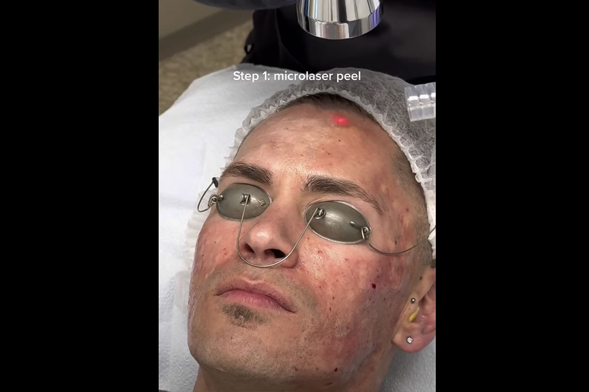 man receiving acne scar removal at South Coast MedSpa