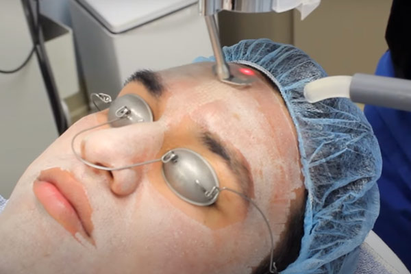 Anthony getting treatment of acne scar removal at South Coast MedSpa