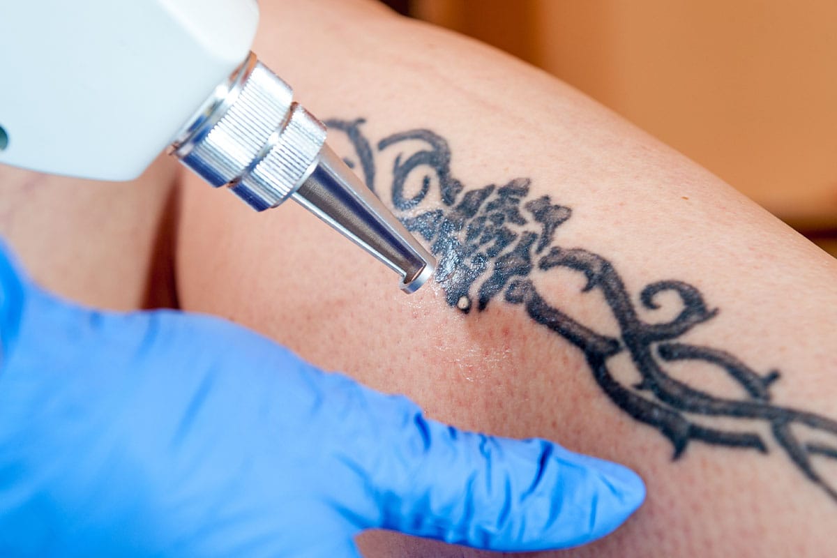 patient during laser tattoo removal in Newport Beach