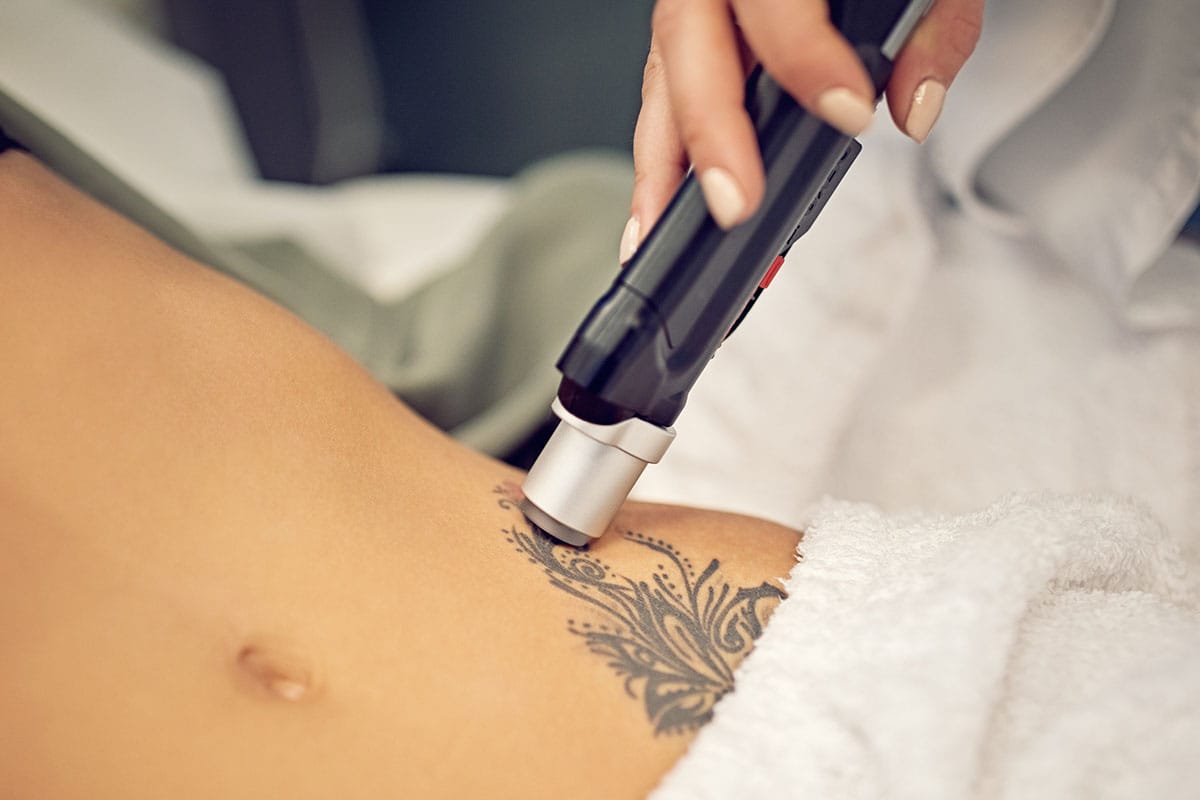 woman during laser tattoo removal in Newport Beach