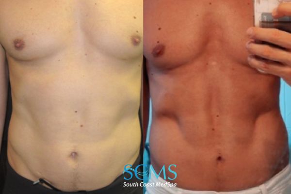 MORPHEUS8 Body - Fat Reduction Before and After