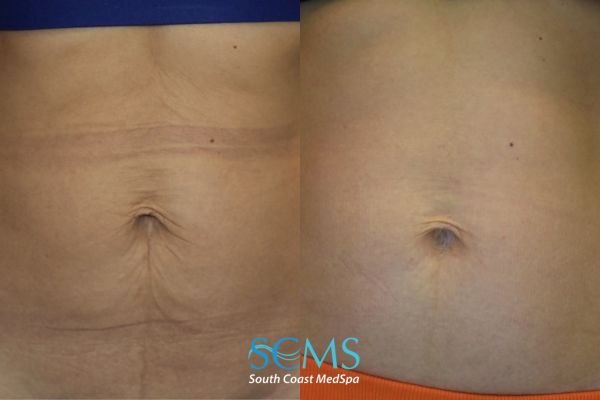 Morpheus8 Before & After Image of loose skin tightened on stomach