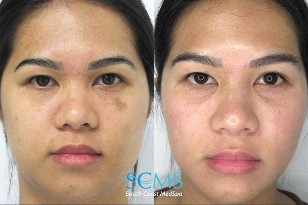 Before and after image of female with medium toned skin. in the after, skin is shown visibly brighter, more evenly toned and a dark spot under the eye is barely visible,