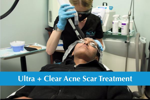Image of a darker skinned female laying on a treatment bed, with a provide administering an Ultra Clear Laser Treatment to her face to treat cystic acne scarring