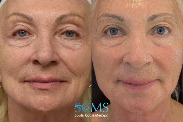 Tatiana looks 10 years younger 6 days after laser coring!