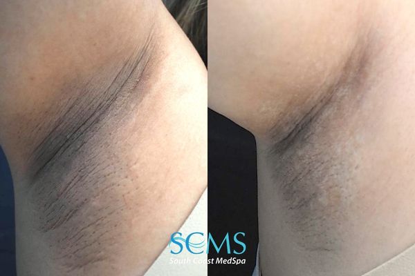 fr pico (2) Before and after underarm comparison showing reduced hyperpigmentation, lightened dark discoloration, and smoother skin texture following PicoSure skin revitalization, South Coast MedSpa.