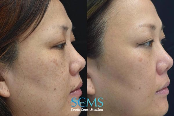 js pico (1) Before and after side profile of a female patient showing reduction in melasma and uneven pigmentation with smoother, clearer skin after PicoSure skin revitalization, South Coast MedSpa.