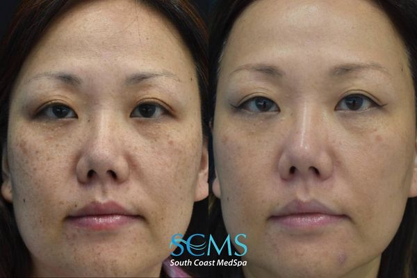 js pico (2) Before and after front view of a female patient showing reduced facial discoloration, fewer visible dark spots, and brighter, more even skin tone following PicoSure skin revitalization, South Coast MedSpa.