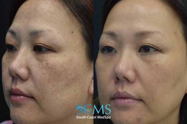 js pico (3) Before and after angled view of a female patient showing reduction in melasma, sun spots, and uneven pigmentation on the cheek after PicoSure skin revitalization, with brighter and more even skin tone, South Coast MedSpa.