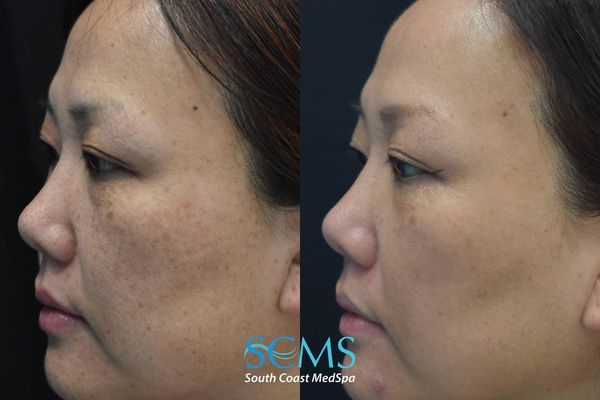js pico (4) Before and after side profile of a female patient showing improvement in hyperpigmentation, clearer skin tone, and smoother texture following PicoSure skin revitalization treatment, South Coast MedSpa.