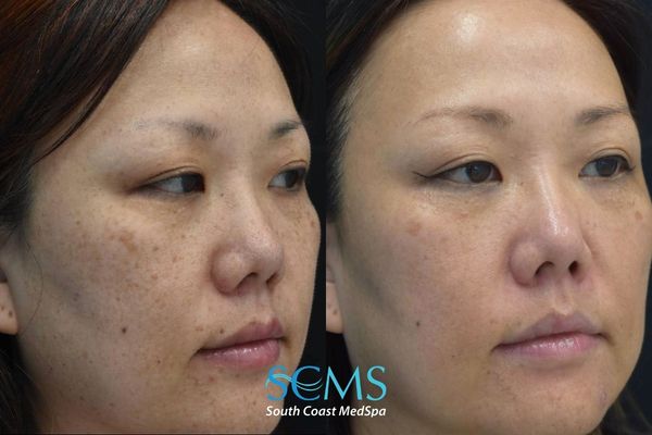 js pico (5) Before and after angled view of a female patient showing decreased brown spots, improved skin clarity, and more uniform complexion after PicoSure skin revitalization, South Coast MedSpa.