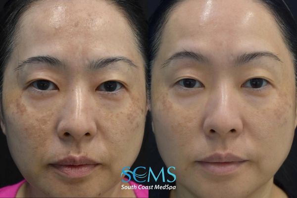 jsu pico (2) Before and after front view of a female patient showing improvement in facial discoloration, reduced brown spots, and more uniform skin tone following PicoSure skin revitalization treatment, South Coast MedSpa