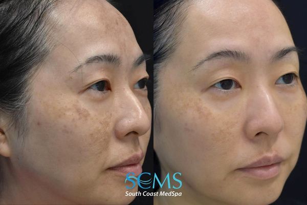 jsu pico (3) Before and after angled view of a female patient showing decreased hyperpigmentation, smoother skin texture, and clearer overall complexion after PicoSure skin revitalization, South Coast MedSpa.