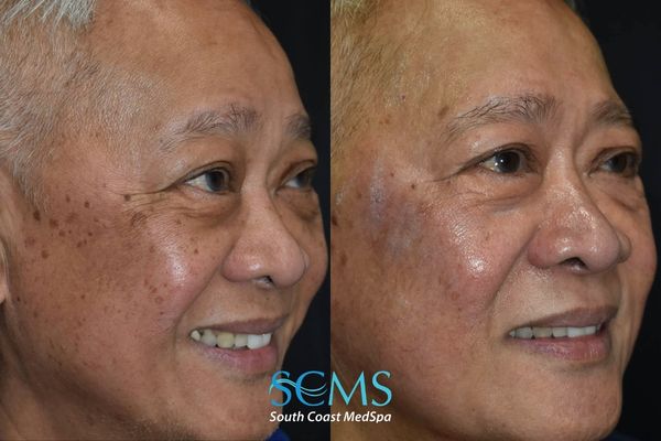 ls pico (1) Before and after angled smiling view of an older male patient showing reduction in sun spots and uneven pigmentation with smoother, more radiant skin after PicoSure skin revitalization, South Coast MedSpa.