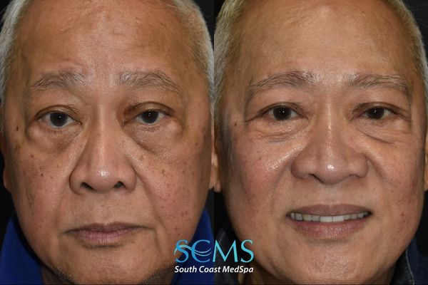 ls pico (2) Before and after front view of an older male patient showing decreased facial discoloration, improved overall skin tone, and brighter complexion following PicoSure skin revitalization, South Coast MedSpa.