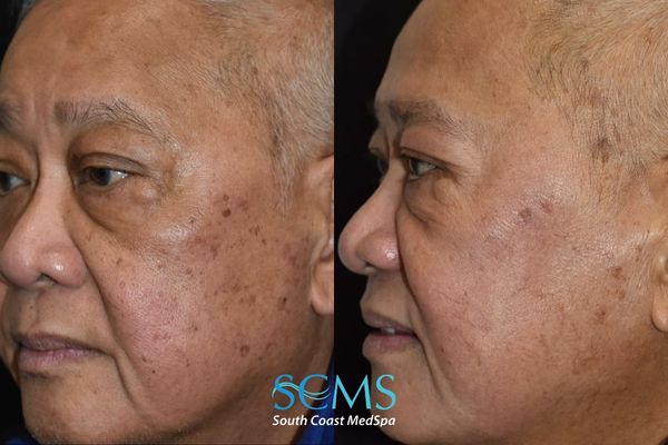 ls pico (3) Before and after oblique view of an older male patient showing reduced brown spots, improved skin clarity, and smoother texture after PicoSure skin revitalization treatment, South Coast MedSpa.