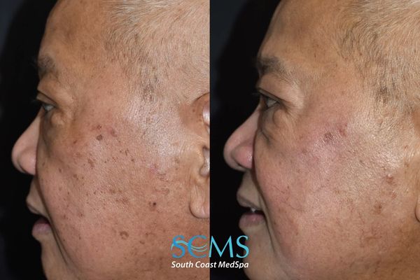 ls pico (4) Before and after side profile of an older male patient showing reduction in dark spots, sun damage, and uneven pigmentation on the cheek after PicoSure skin revitalization, with brighter and smoother skin tone, South Coast MedSpa.