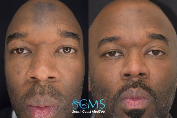 ah pico (1) Front view before and after Pico Skin Revitalization treatments showing significant reduction in forehead pigmentation, brighter complexion, and more even overall skin tone