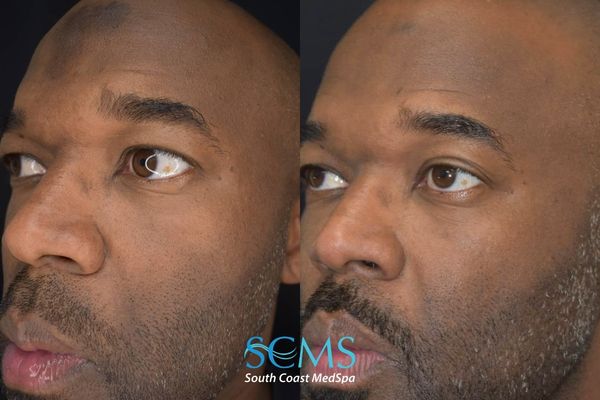 ah pico (2) Male patient before and after 3 Pico Skin Revitalization treatments showing improved skin clarity, reduced pigmentation on forehead and cheeks, and more even skin tone from angled view
