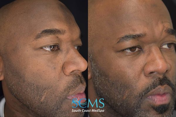 ah pico (3) Side profile before and after Pico Skin Revitalization treatments demonstrating reduction in forehead pigmentation, smoother skin texture, and more uniform skin tone along cheek and jawline