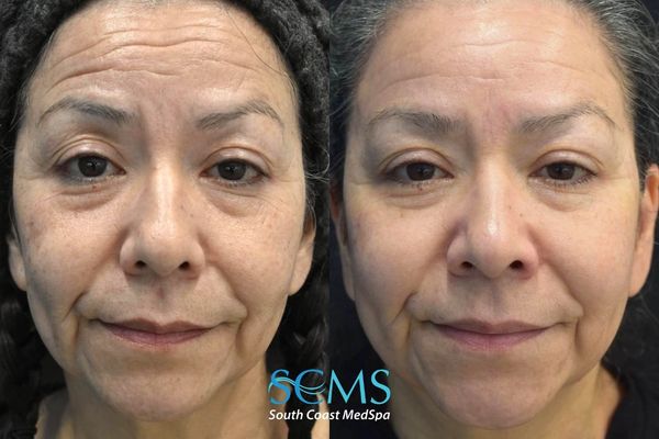 am M8+pico (1) Before and after front-facing facial comparison demonstrating improved skin tone, texture, pigmentation, and overall rejuvenation following Morpheus8 and Pico laser treatments at South Coast MedSpa.