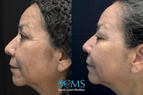 am M8+pico (2) Before and after side profile facial rejuvenation results showing smoother skin, improved firmness, reduction in fine lines, and brighter overall complexion after Morpheus8 and Pico laser treatments at South Coast MedSpa.