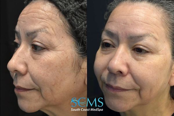 am M8+pico (3) Before and after angled facial comparison highlighting improvement in skin clarity, texture, uneven pigmentation, and facial rejuvenation following combined Morpheus8 and Pico laser treatments.