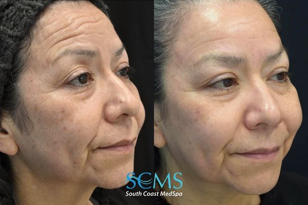 am M8+pico (4) Before and after three-quarter facial view demonstrating smoother skin texture, improved tone, reduction in pigmentation, and softened fine lines after Morpheus8 and Pico laser treatments at South Coast MedSpa.