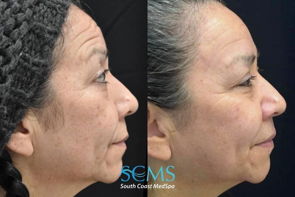 am M8+pico (5) Before and after side profile comparison showing improvement in skin texture, fine lines, pigmentation, and overall skin firmness after 3 Morpheus8 treatments and 3 Pico laser treatments at South Coast MedSpa.