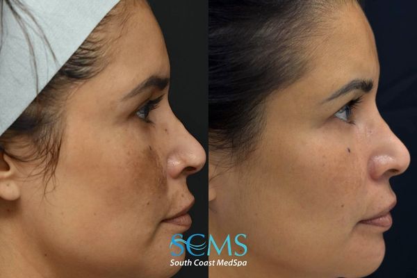 cl pico+3d miracl (1) Before and after side facial comparison demonstrating improvement in pigmentation, skin brightness, texture, and overall complexion after a series of 3 Pico laser treatments and 3 3DMIRACL treatments at South Coast MedSpa.