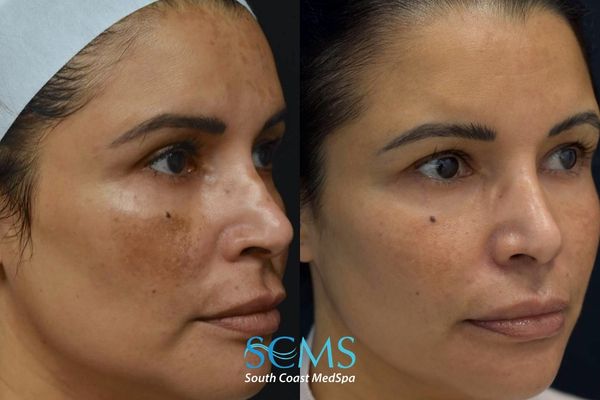 cl pico+3d miracl (2) Before and after three-quarter facial view showing reduction in dark spots, more even skin tone, smoother texture, and healthier-looking skin following 3 Pico laser and 3 3DMIRACL treatments at South Coast MedSpa.