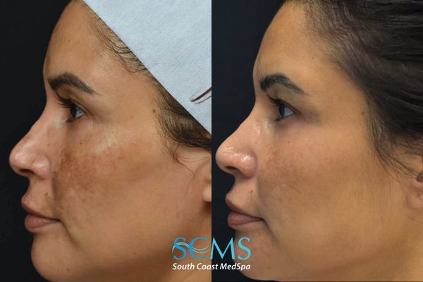 cl pico+3d miracl (4) Before and after side profile comparison demonstrating reduction in pigmentation, improved skin tone, smoother texture, and brighter complexion following 3 Pico laser treatments and 3 3DMIRACL treatments at South Coast MedSpa.