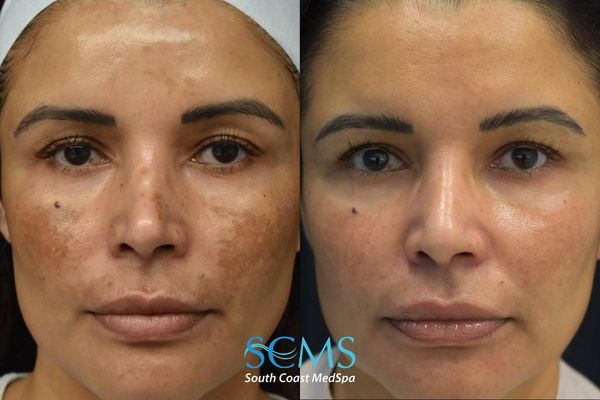 cl pico+3d miracl (5) Before and after front-facing facial comparison showing significant improvement in pigmentation, melasma, uneven skin tone, and overall skin clarity after 3 Pico laser treatments and 3 3DMIRACL treatments at South Coast MedSpa.