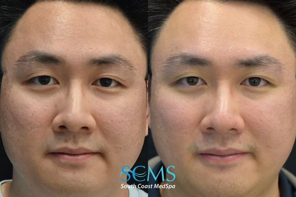id ASR (1) Front view of male patient with Fitzpatrick skin type III–IV before and after UltraClear ASR with PRP and Lumecca showing clearer skin, reduced redness, more even tone, and smoother overall complexion