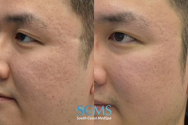 id ASR (2) Side view of male with Fitzpatrick skin type III–IV before and after UltraClear ASR, PRP, and Lumecca demonstrating refined skin texture, less visible pores, and softened acne scars