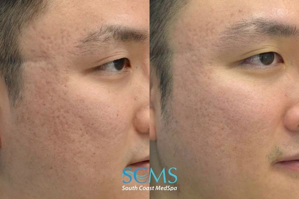 id ASR (3) Male patient with Fitzpatrick skin type III–IV before and after UltraClear ASR with PRP and Lumecca showing smoother skin texture, reduced pore appearance, and improvement in mild acne scarring on the cheek
