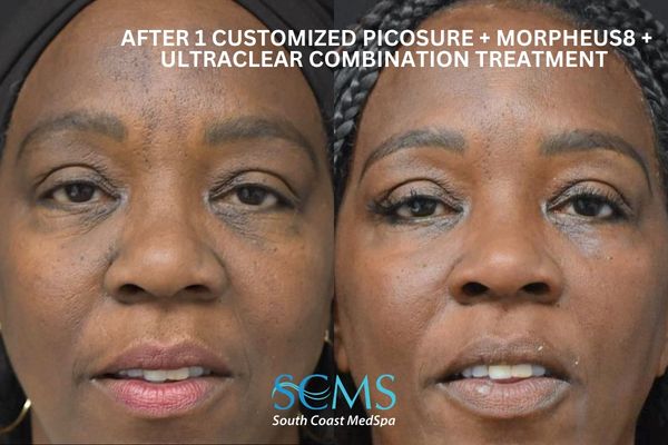le ASR+M8+pico (1) (2) Before and after front view of an adult Black female patient following 1 customized PicoSure, Morpheus8, and UltraClear combination treatment, showing more even skin tone, smoother texture, and overall skin rejuvenation, SCMS South Coast MedSpa logo visible