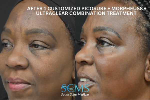 le ASR+M8+pico (2) (2) Before and after side profile of an adult Black female patient following 1 customized PicoSure, Morpheus8, and UltraClear combination treatment at South Coast MedSpa, showing smoother skin texture, improved tone, and reduced fine lines and uneven pigmentation, SCMS logo visible