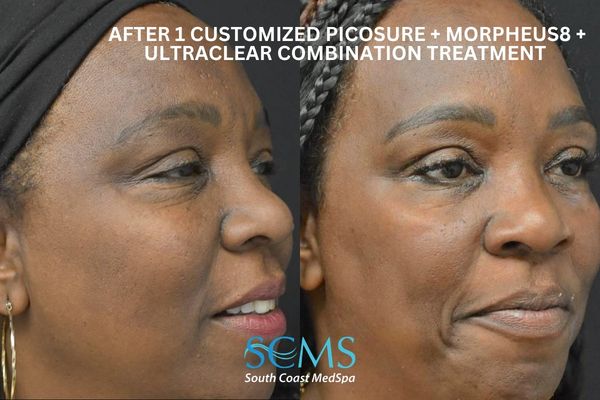 le ASR+M8+pico (3) (1) Before and after angled side view of an adult Black female patient after 1 customized PicoSure, Morpheus8, and UltraClear combination treatment, showing improved skin clarity, reduced discoloration, and refined texture, South Coast MedSpa SCMS branding visible