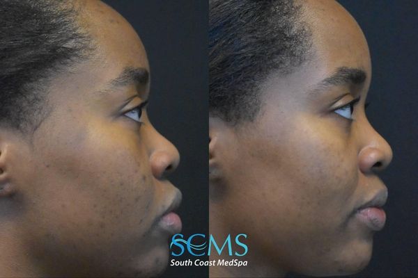 pm pico (1) Full side profile of female patient, Fitzpatrick skin type V, before and after 2 PicoSure treatments demonstrating reduction in acne, smoother skin surface, and improved overall skin clarity